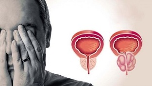 αιτίες της προστατίτιδας στους άνδρες